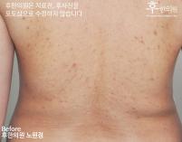 치료 전