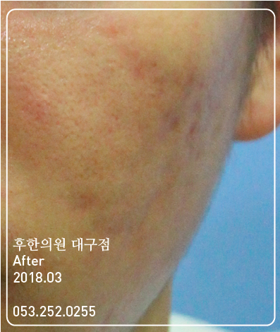 치료 후