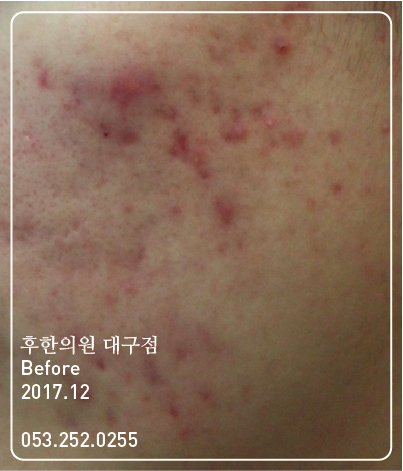 치료 전