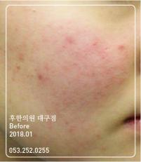 치료 전