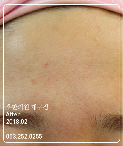 치료 후