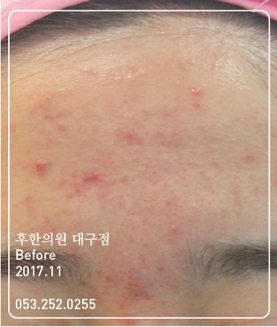 치료 전