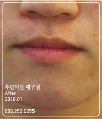 치료 후