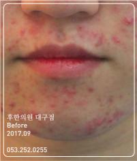 치료 전
