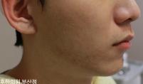 치료 후