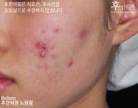 치료 전