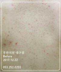 치료 전