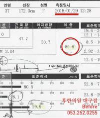 치료 전