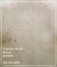 치료 전