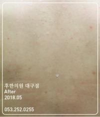 치료 후