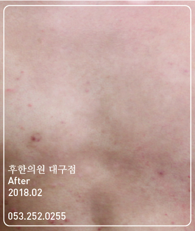 치료 후
