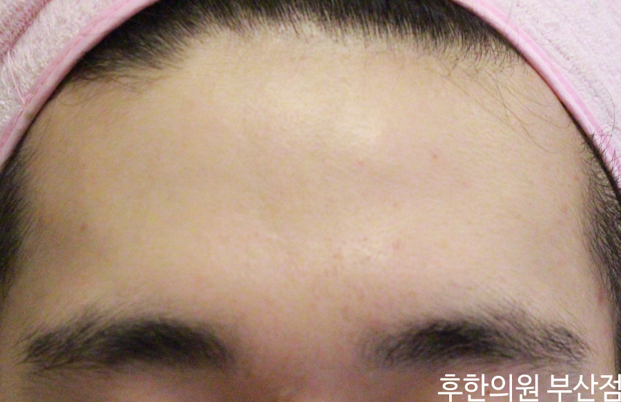 치료 후