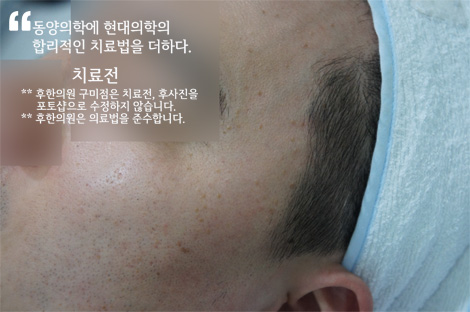 치료 전