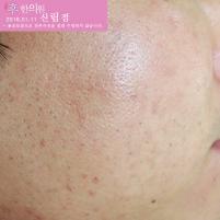 치료 후