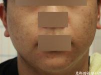 치료 전