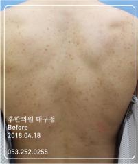 치료 전