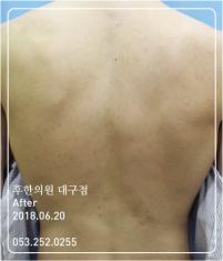 치료 후