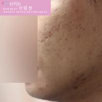 치료 후