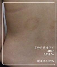 치료 후