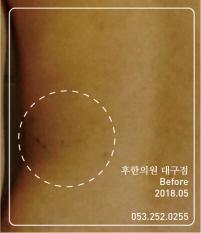 치료 전