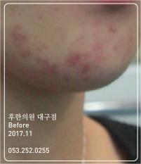 치료 전