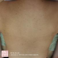 치료 후
