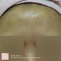 치료 후