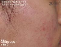 치료 후