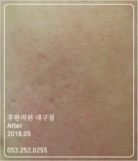 치료 후