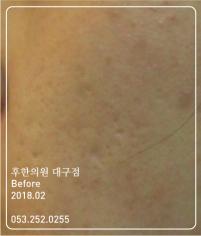 치료 전