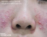 치료 전