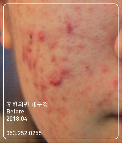 치료 전
