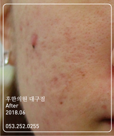 치료 후