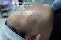 치료 전