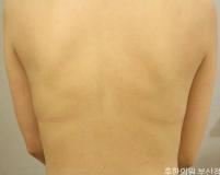 치료 후