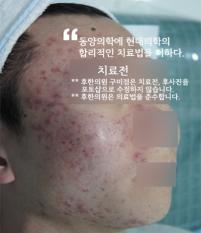 치료 전