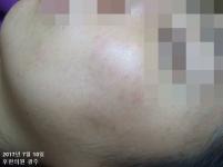 치료 후