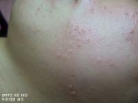 치료 전