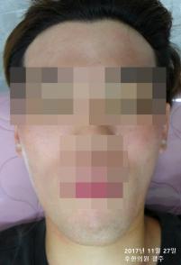 치료 후