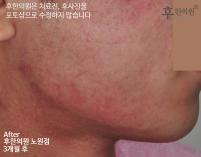 치료 후