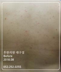 치료 전