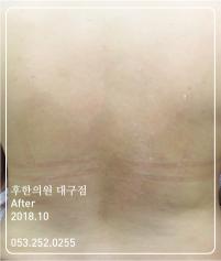 치료 후