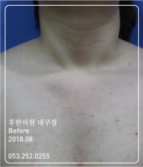 치료 전