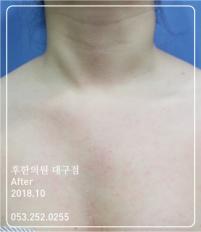 치료 후