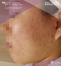 치료 후