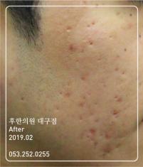 치료 후