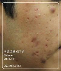 치료 전