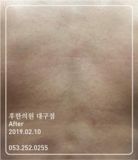 치료 후