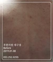 치료 전