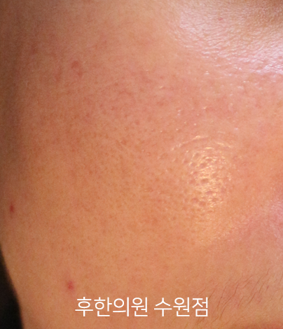 치료 후